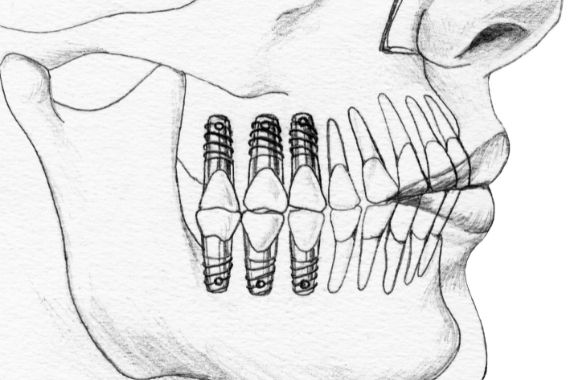 imagen de implantes dentales en ondarreta