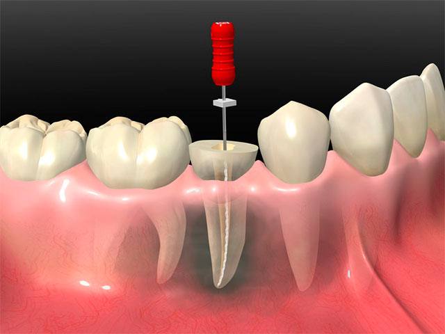 imagen de endodoncia clinica dental Premià