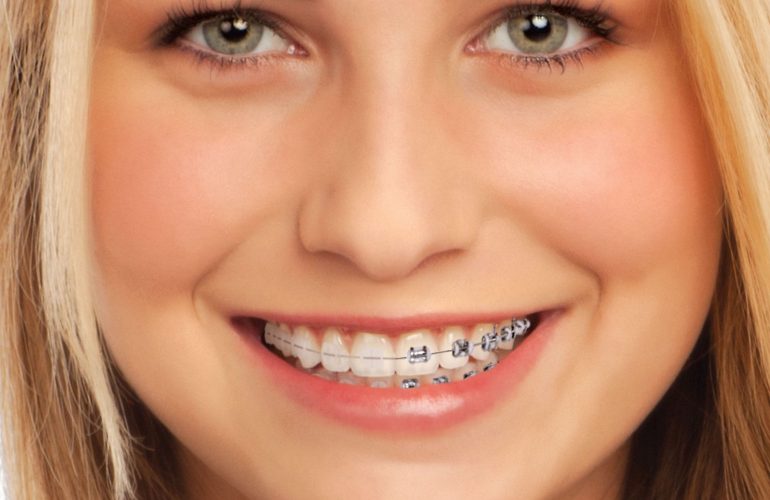 imagen de brackets-cerámica-ortodoncia-clinica-dental-Premià