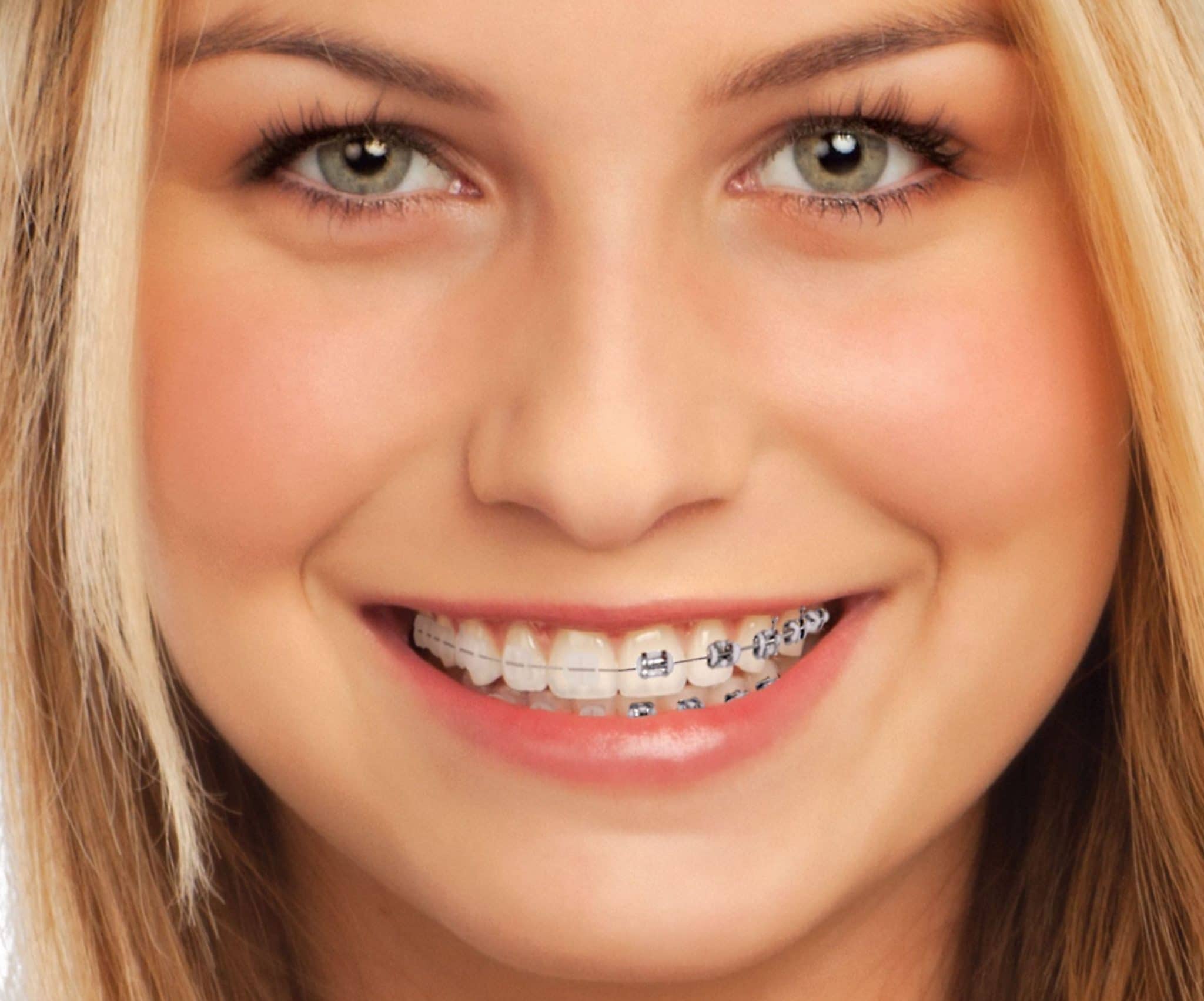 imagen de brackets-cerámica-ortodoncia-clinica-dental-Premià