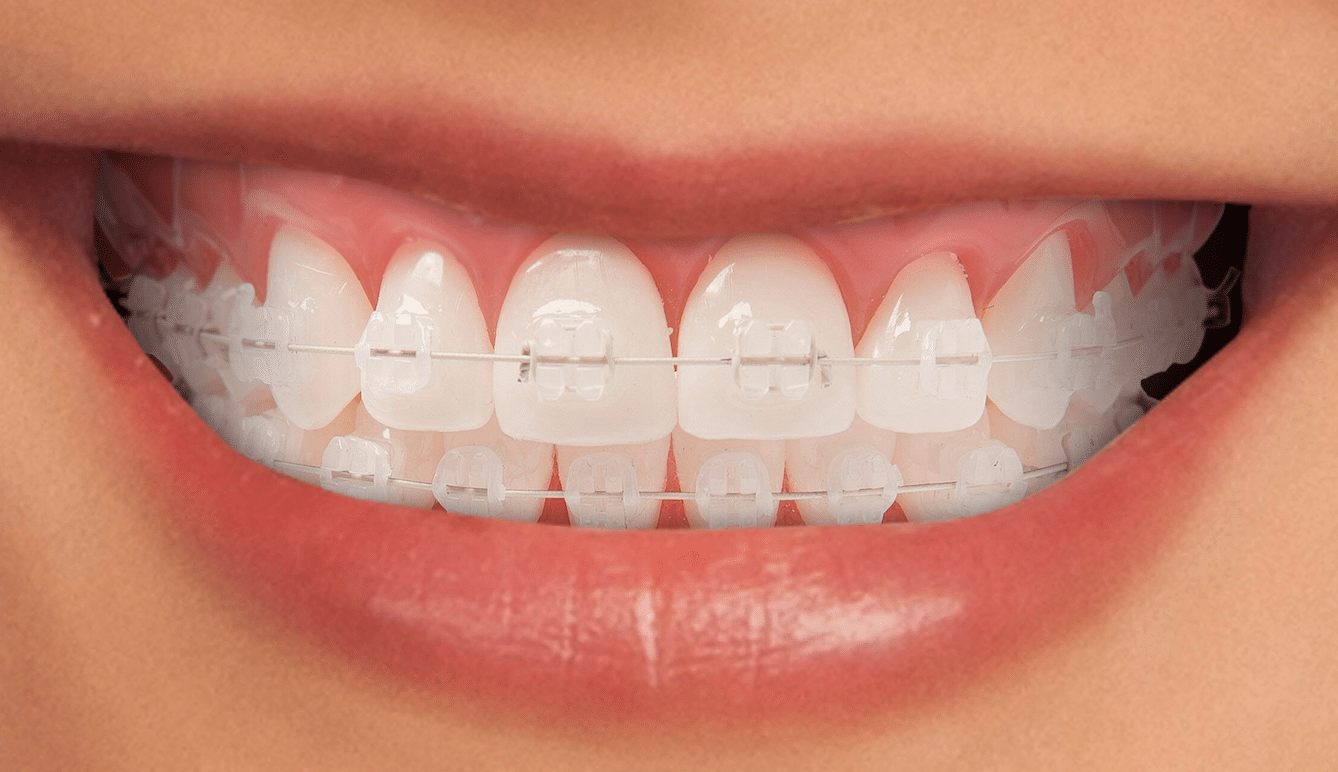 imagen de ortodoncia estetica brackets clinica dental Premià