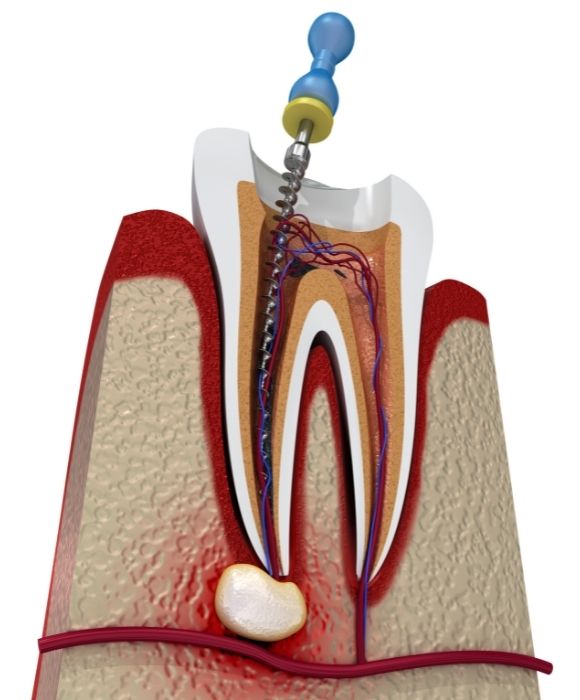 imagen de endodoncia en ondarreta
